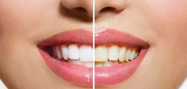 15 Secrets pour des dents éclatantes : votre sourire va rayonner