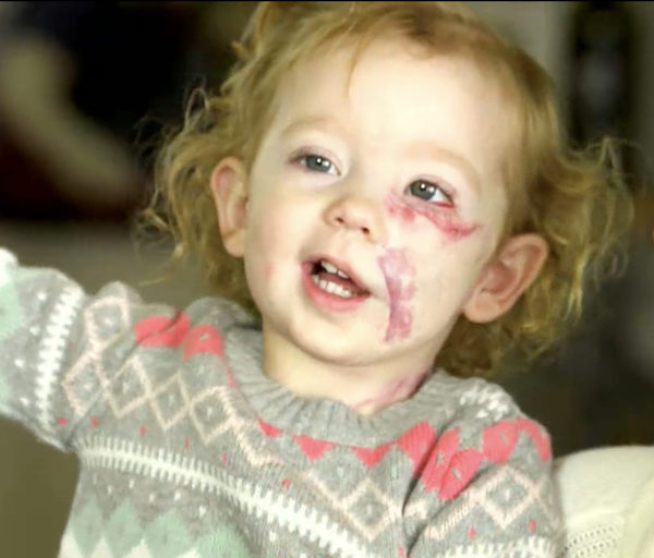 Découvrez l'incroyable transformation de cette petite fille, née avec une tumeur géante sur le visage, 2 ans après