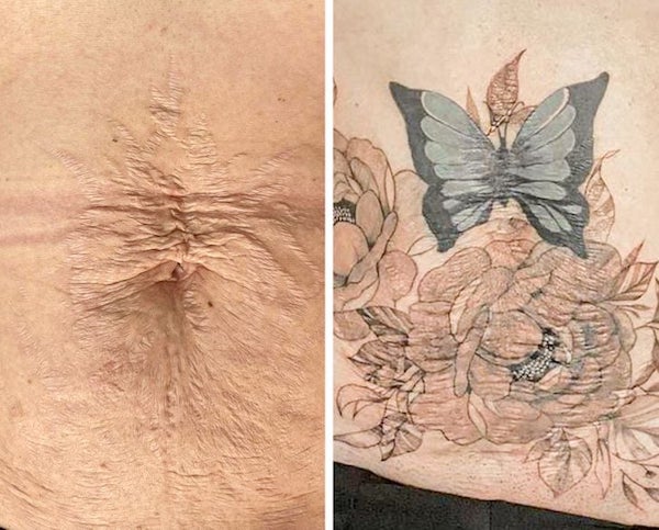 Des tatouages ​​qui aident à transformer vos cicatrices en quelque chose de beau