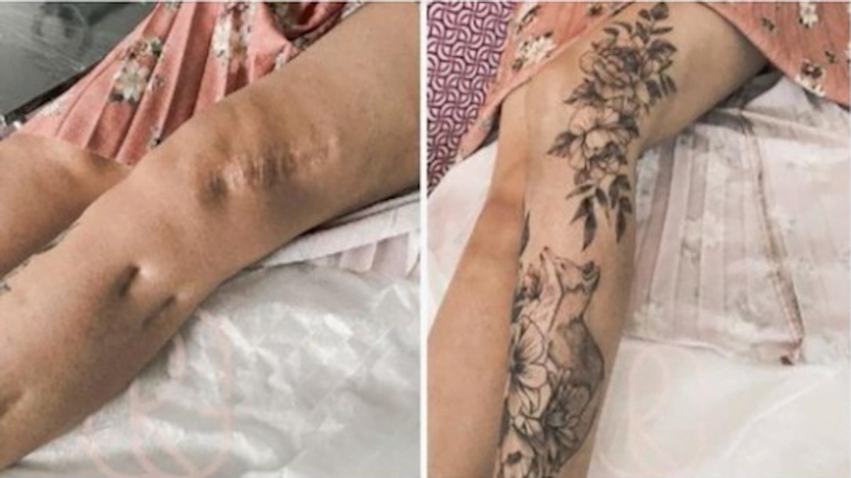 Des tatouages ​​qui aident à transformer vos cicatrices en quelque chose de beau