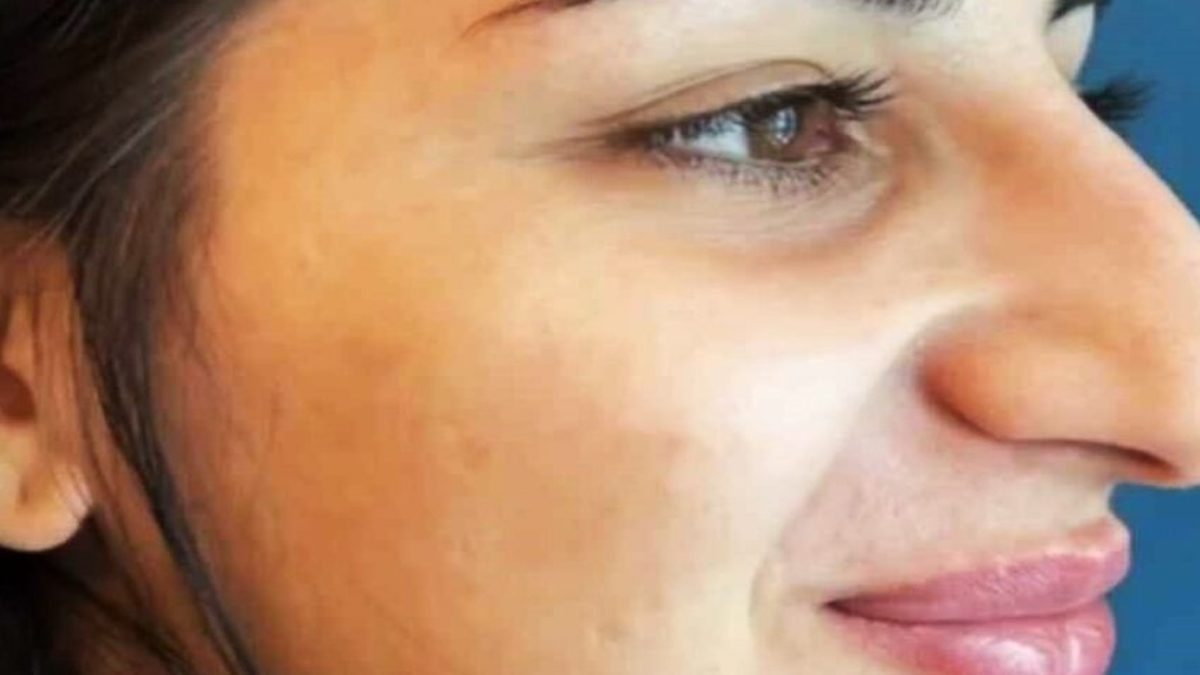 Métamorphose époustouflante : découvrez comment la rhinoplastie d'une jeune femme a conquis des milliers de cœurs