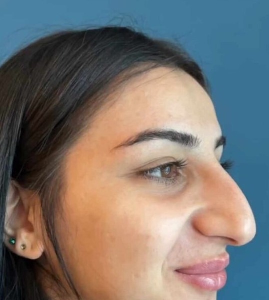 Métamorphose époustouflante : découvrez comment la rhinoplastie d'une jeune femme a conquis des milliers de cœurs