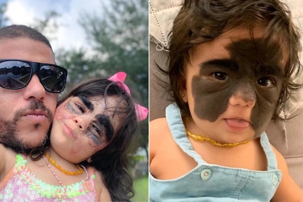 Une jeune fille moquée pour sa marque « Batman » sur le visage : découvrez sa transformation incroyable qui laisse tout le monde sans voix