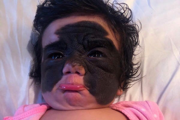 Une jeune fille moquée pour sa marque « Batman » sur le visage : découvrez sa transformation incroyable qui laisse tout le monde sans voix