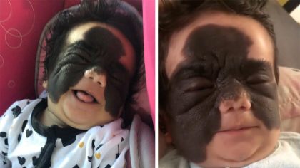 Une jeune fille moquée pour sa marque « Batman » sur le visage : découvrez sa transformation incroyable qui laisse tout le monde sans voix