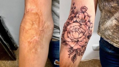 Des tatouages ​​qui aident à transformer vos cicatrices en quelque chose de beau