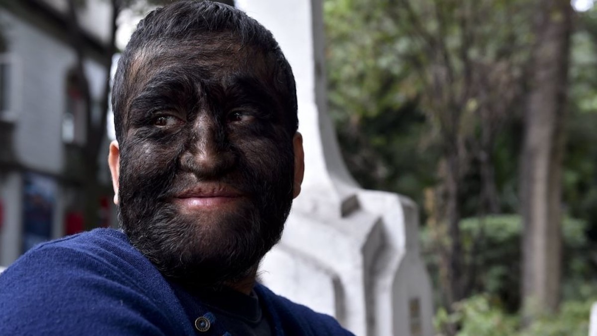 "L'Homme aux loups" s'est caché des gens à cause de son apparence et a ensuite eu des filles qui lui ressemblent