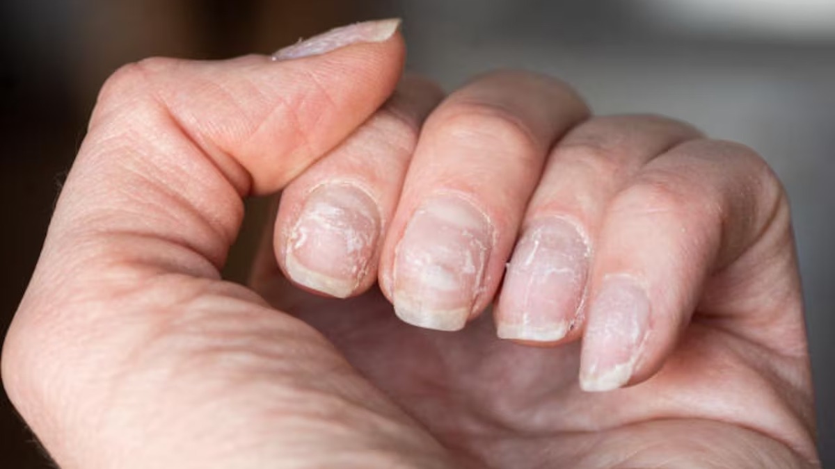 Taches blanches sur les ongles : quelle en est l’origine ?