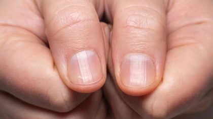 Taches blanches sur les ongles - quelle en est l'origine ?