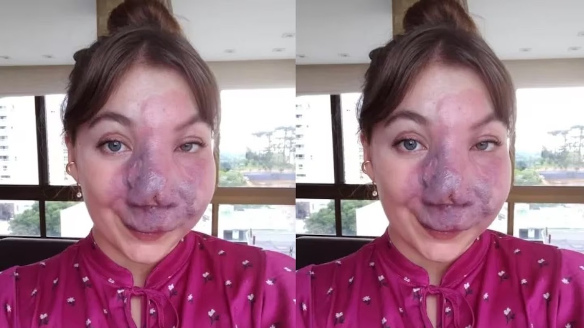 Une femme atteinte d'un hémangiome au visage est critiquée depuis qu'elle est enfant : « ils me regardent avec peur et pitié, mais j'aime mon visage »