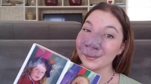 Une femme atteinte d'un hémangiome au visage est critiquée depuis qu'elle est enfant : « ils me regardent avec peur et pitié, mais j'aime mon visage »