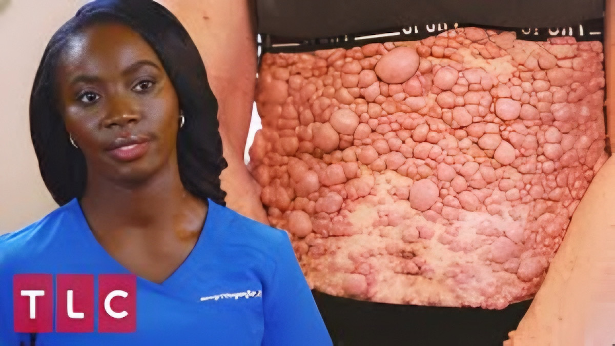 Vidéo : le cas le plus extrême de neurofibromatose du Dr Mercy, dermatologue