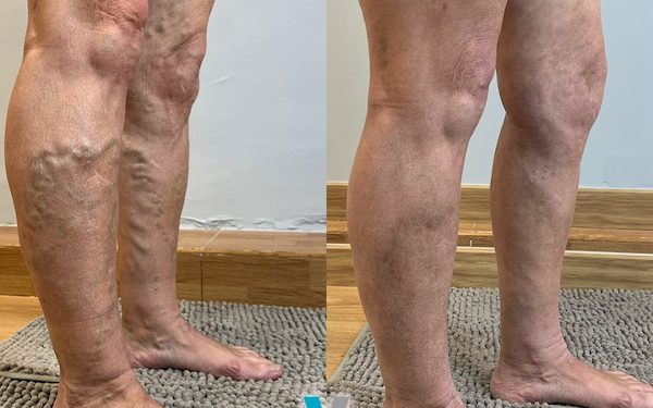 Ces photos inédites de Varices à ne pas manquer