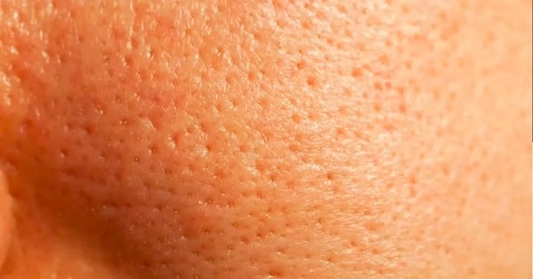 Vidéo : 7 choses qui obstruent vos pores et provoquent de l'acné