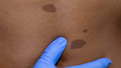 Vidéo : le cas le plus extrême de neurofibromatose du Dr Mercy, dermatologue