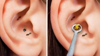 Vidéo : points noirs sur l'oreille