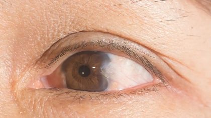 Yeux charnus (Ptérygion) : causes, symptômes et traitements