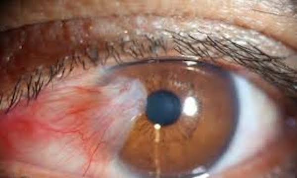 Yeux charnus (Ptérygion) : causes, symptômes et traitements