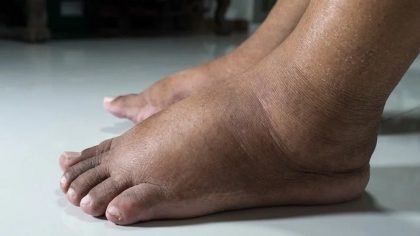 10 conseils de podologues pour éviter les pieds et chevilles gonflés