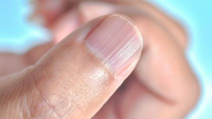 Ce que révèlent réellement vos ongles égratignés sur votre santé