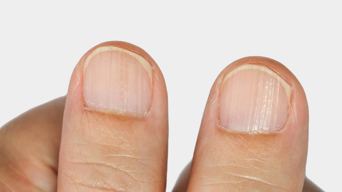 Ce que révèlent réellement vos ongles égratignés sur votre santé