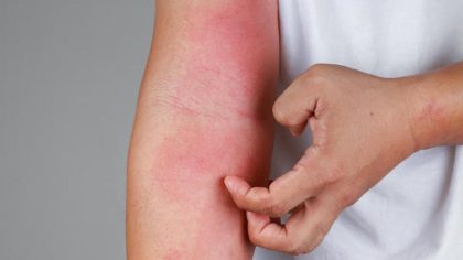 Comment savoir si cette rougeur sur votre peau est une rosacée, une allergie ou une dermatite