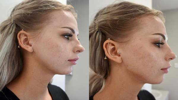 "Jawline Contouring" : ce soin pour affiner le visage connaît un véritable succès depuis le confinement