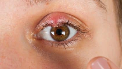 Yeux charnus (Ptérygion) : causes, symptômes et traitements