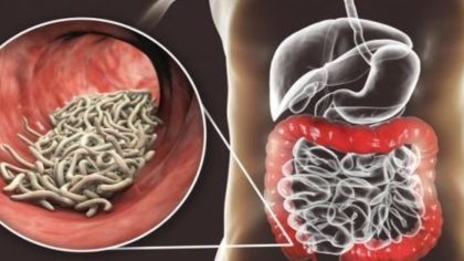 10 signes que votre corps est infesté de parasites et 7 aliments qui vous aideront à les éliminer