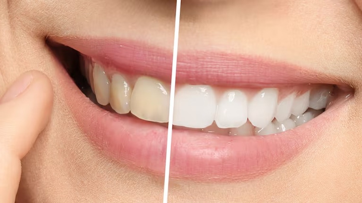 3 astuces éprouvées pour avoir des dents blanches rapidement