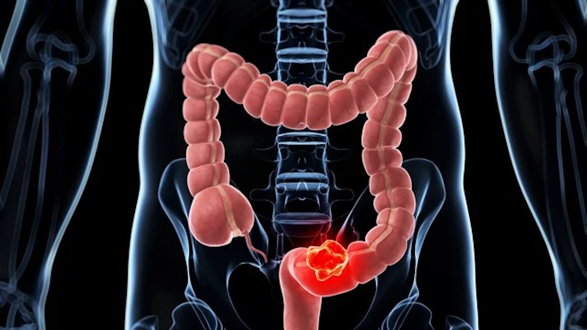 Cancer du côlon : symptômes et causes