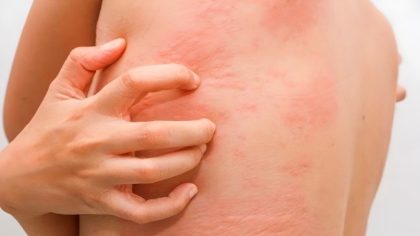 Comment savoir si cette rougeur sur votre peau est une rosacée, une allergie ou une dermatite