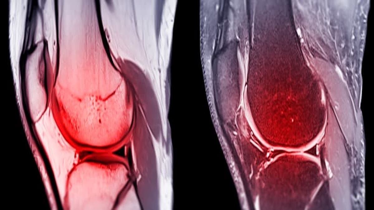 Des scientifiques mettent au point un biomatériau capable de régénérer le cartilage endommagé dans les articulations