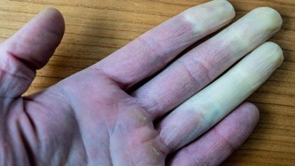 Maladie de Raynaud : symptômes et causes