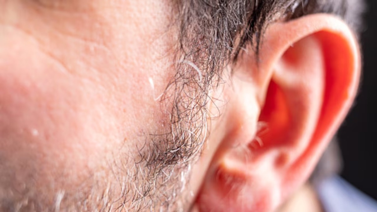 Pourquoi des poils apparaissent dans l’oreille ?