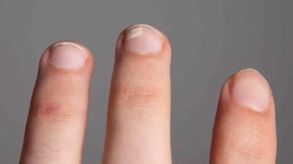 Taches blanches sur les ongles : quelle en est l’origine ?