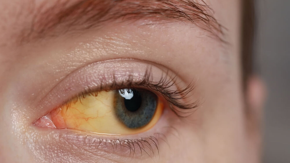 Yeux jaunes ou jaunis: quelles en sont les causes et comment les traiter ?