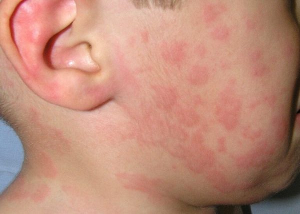 Mon enfant a de l'urticaire. L’urticaire est-elle la même chose que les allergies ?