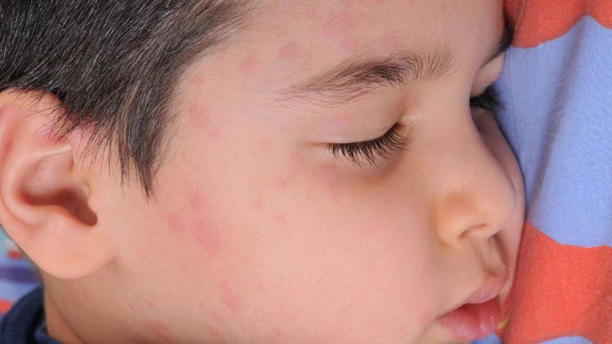 Mon enfant a de l'urticaire. L’urticaire est-elle la même chose que les allergies ?